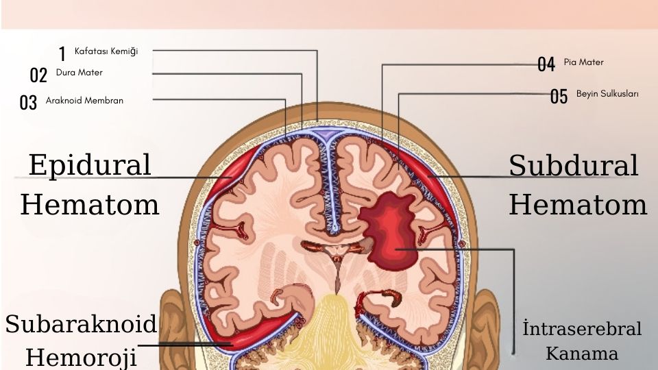 Epidural Hematom Nedir Belirtileri Nedenleri Tedavisi Drcem